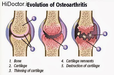 Arthritis-Osteoarthritis-Stages