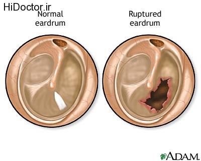 ruptured-eardrum
